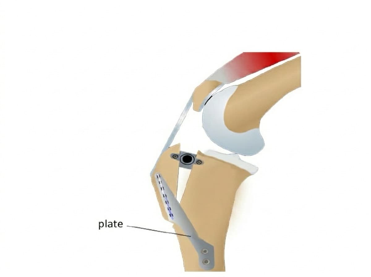 TTA and the Other Osteotomies
