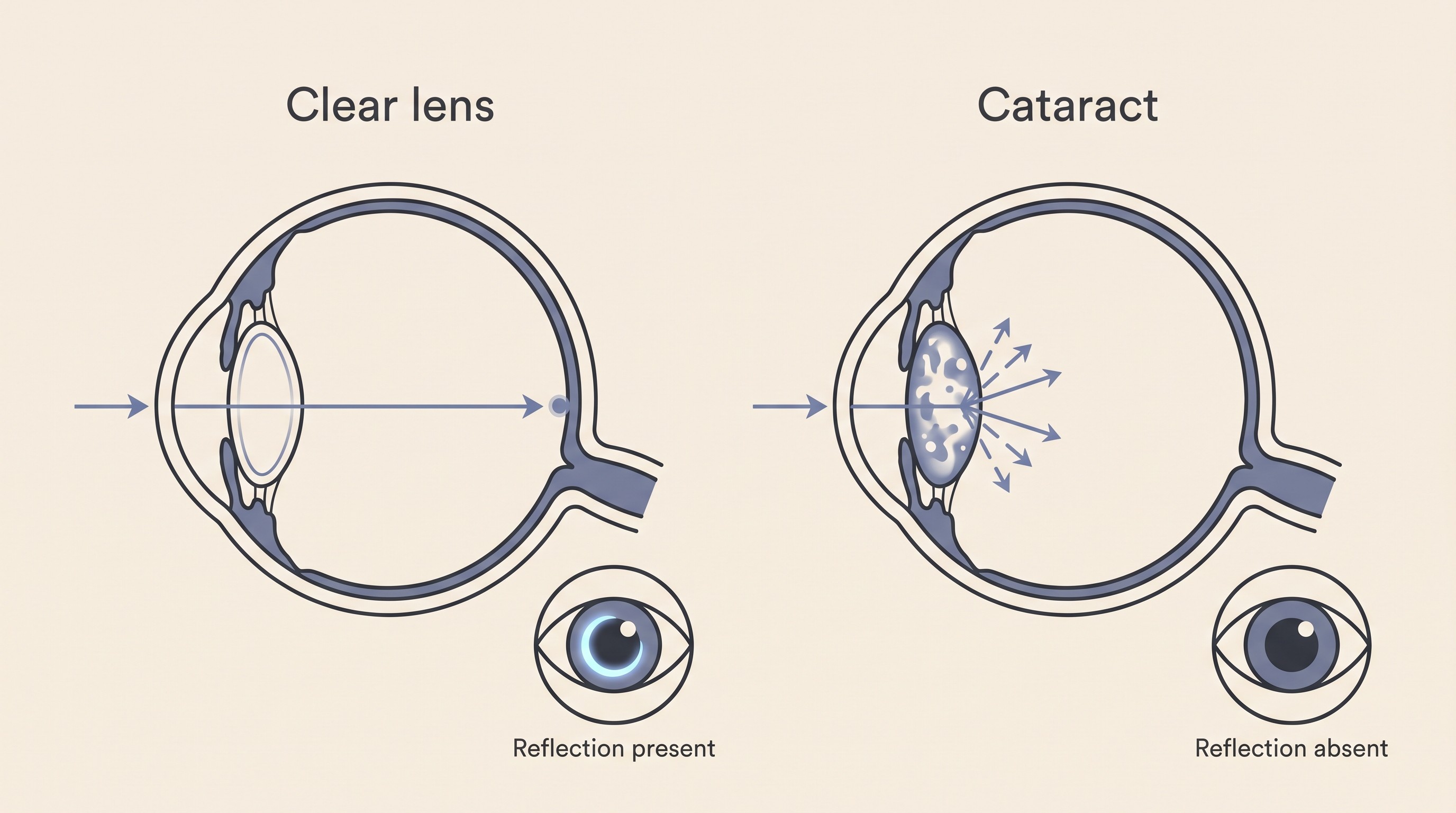 Side-by-side flat illustration on cream of a clear healthy eye lens letting light reach the retina next to a cloudy cataractous lens blocking the light, with a small inset showing the tapetal reflection present in one and absent in the other