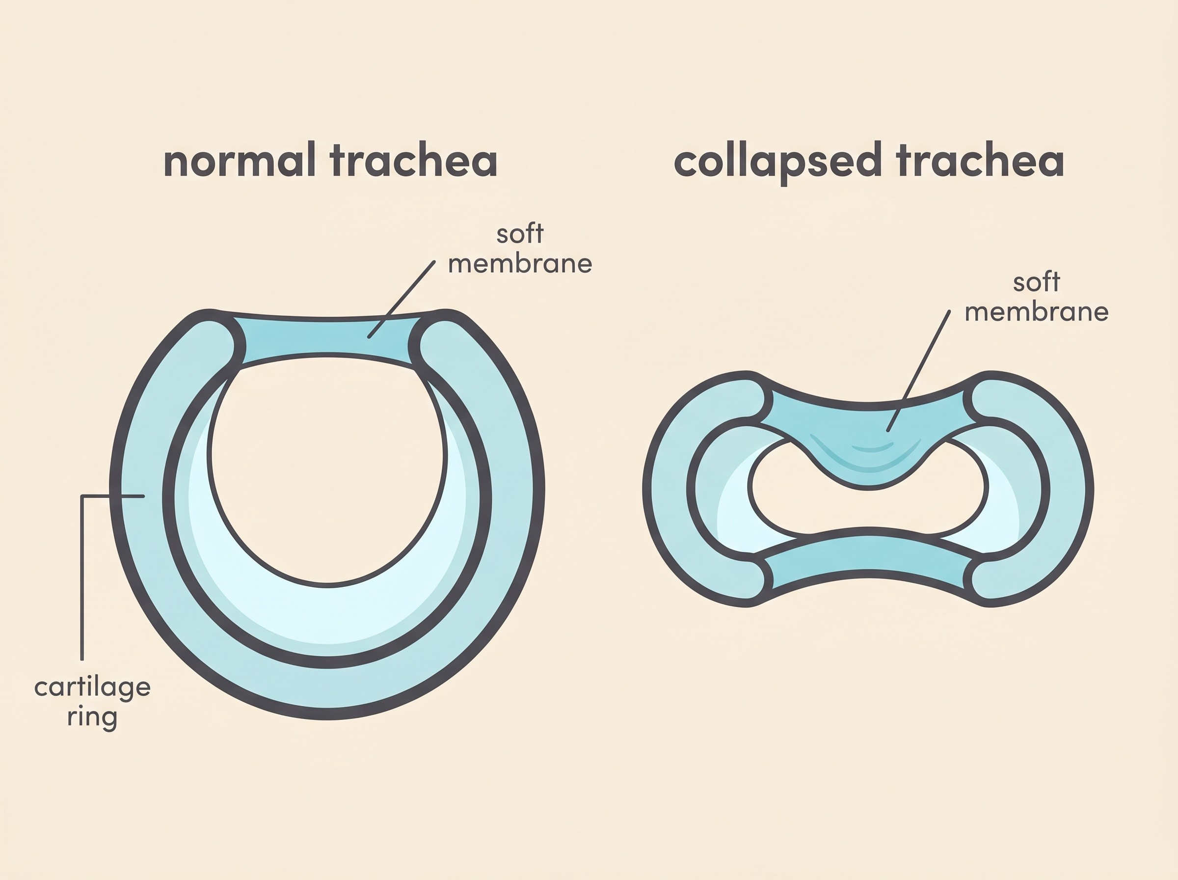 Cross-section diagram comparing a round, open normal trachea with a flattened, collapsed trachea, both labelled, in a flat-vector style on a cream background