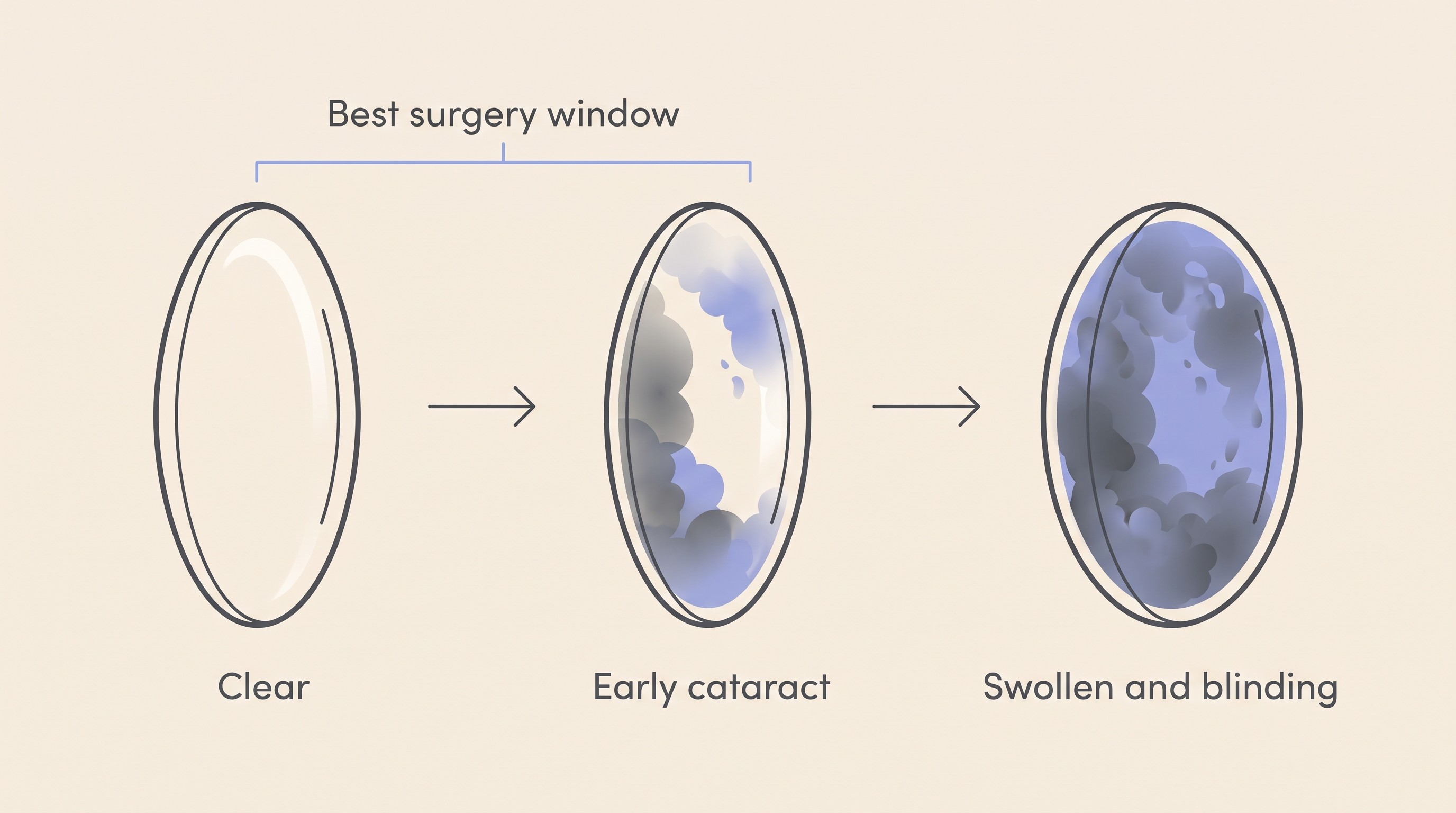 A three-stage strip on cream showing a clear healthy lens on the left, an early diabetic cataract in the middle, and a swollen mature intumescent cataract on the right, with arrows indicating days-to-weeks progression and a marker showing the early window where surgery works best