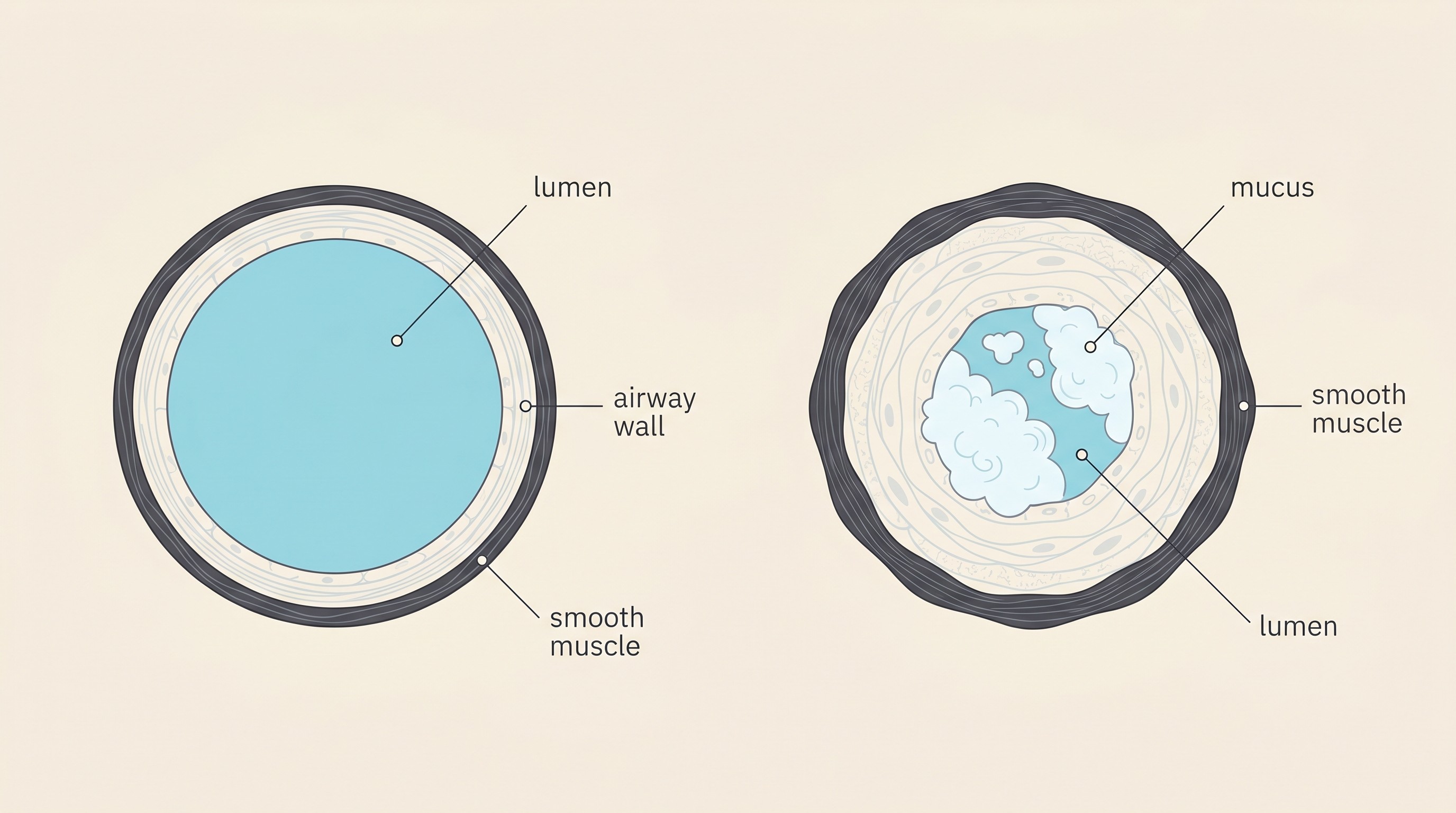 A flat-vector cross-section on a cream background showing a healthy open feline airway beside a narrowed asthmatic one, the second with a thickened inflamed wall, tightened smooth muscle and a mucus-clogged lumen