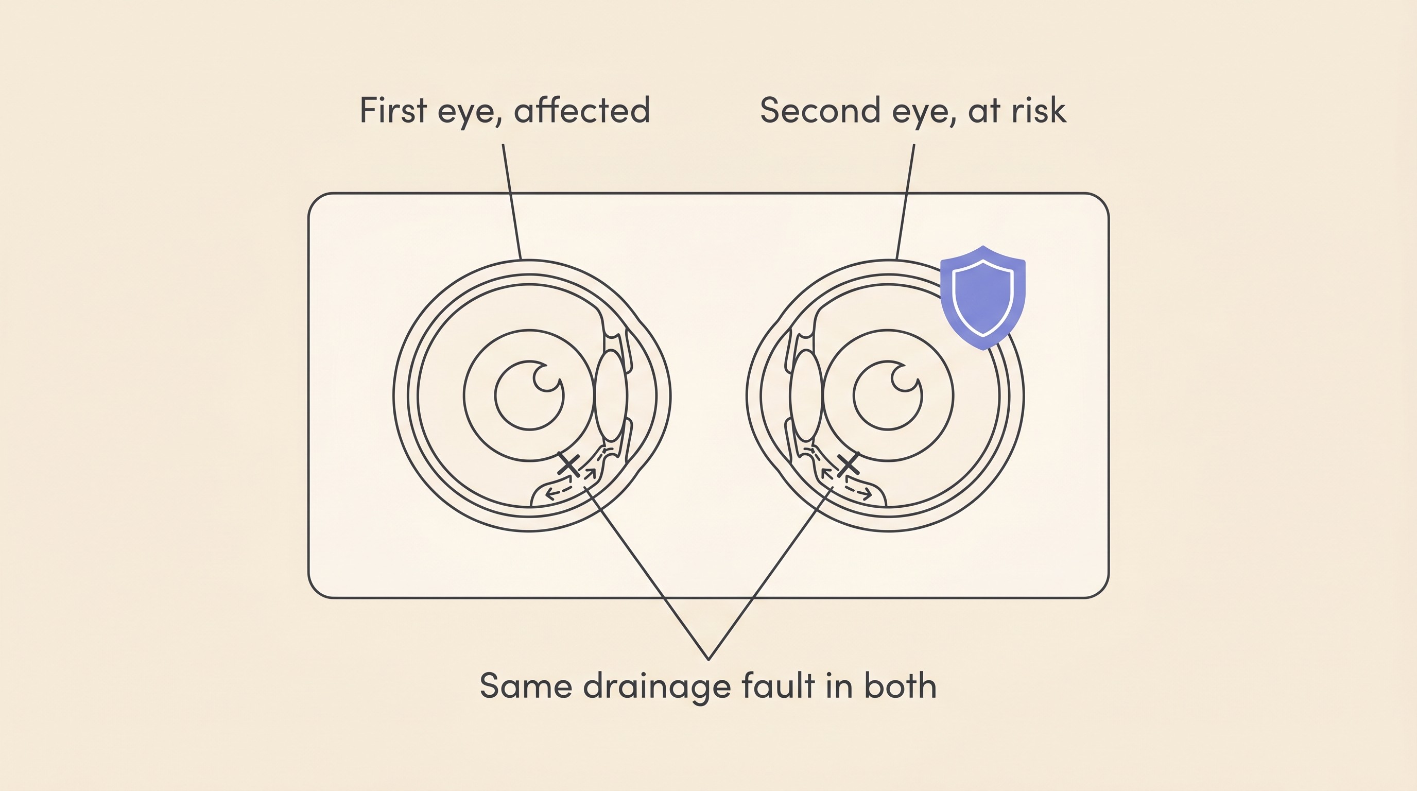 Flat illustration on cream of a dog's two eyes, the first eye marked as affected and the second eye marked at risk, with a faulty drainage angle shown in both and a shield over the second eye