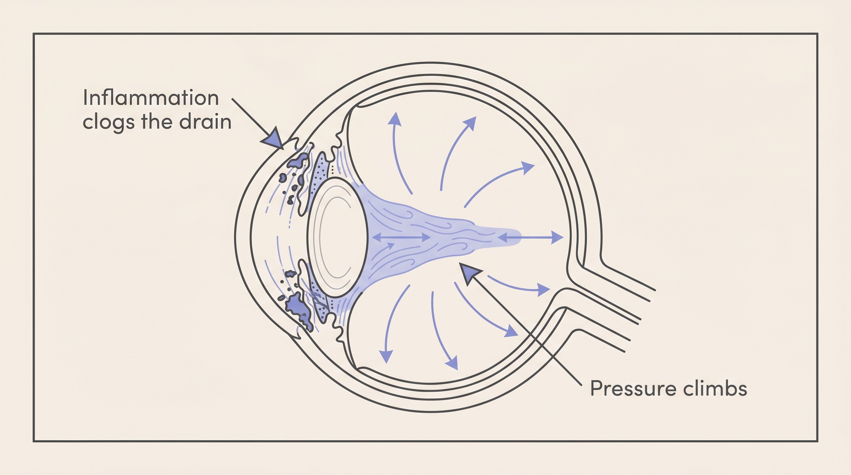 Flat illustration of a cat eye in cross-section showing inflammatory debris clogging and scarring the drainage angle, with fluid building up and the pressure rising