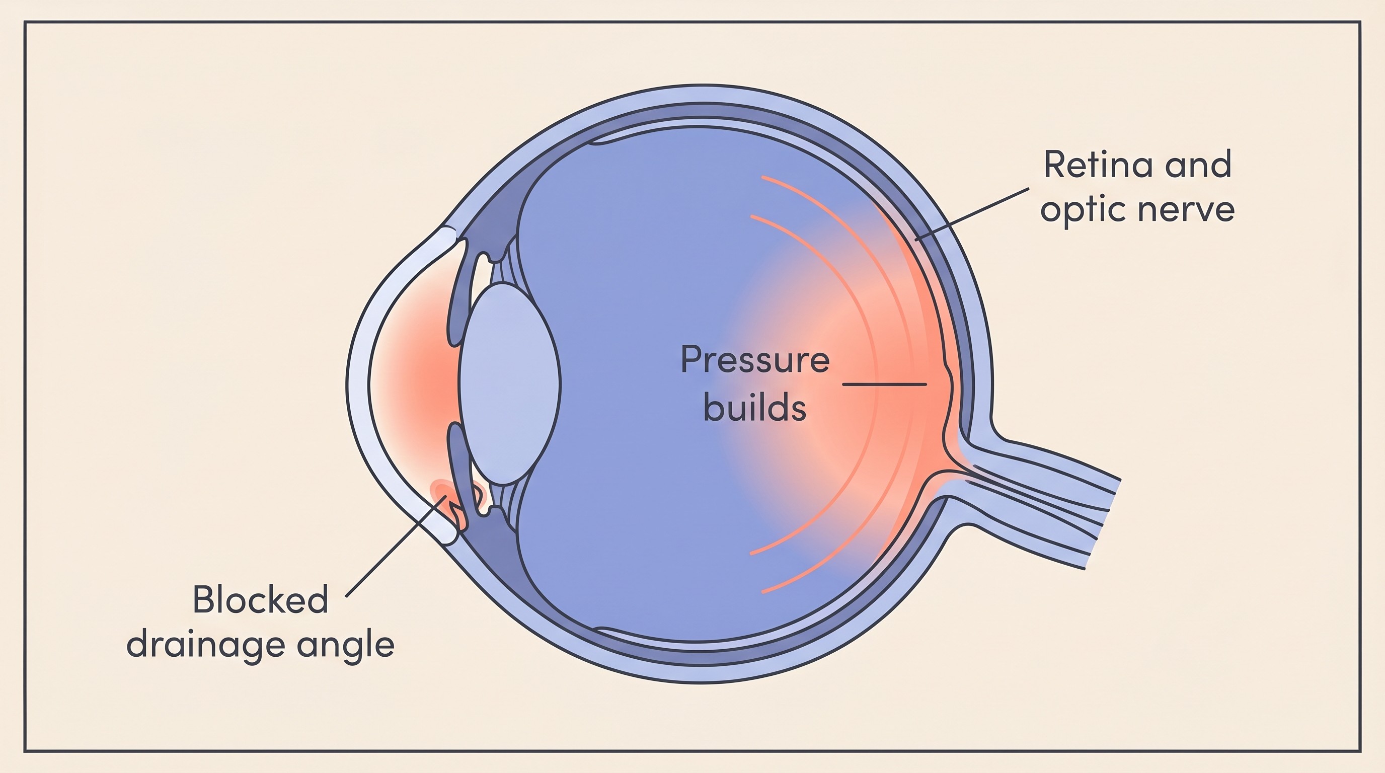 Flat illustration of a dog's eye in cross-section showing aqueous fluid building up behind a blocked drainage angle, pressing on the retina and optic nerve at the back