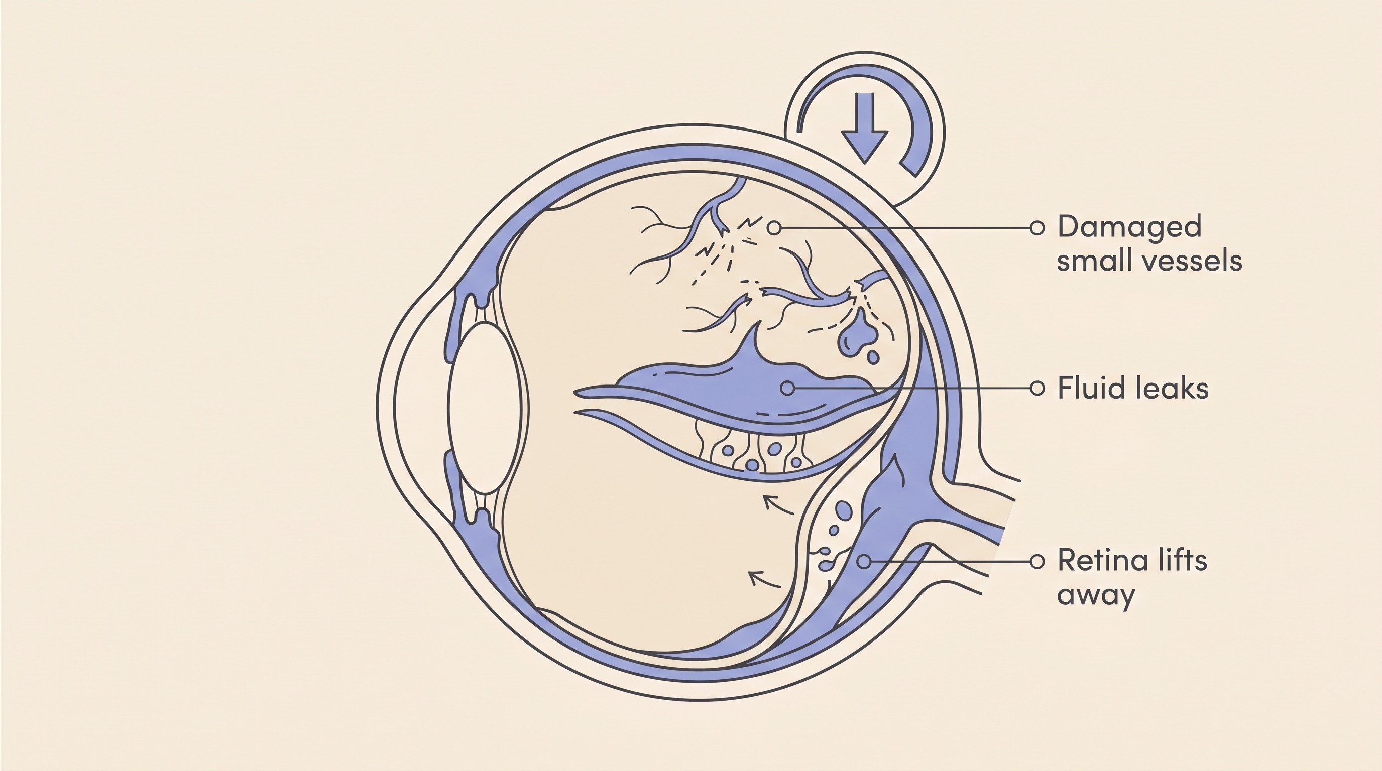 Cross-section of the back of a pet's eye showing high blood pressure damaging the small vessels, with leaking fluid and blood lifting the retina away from the back of the eye