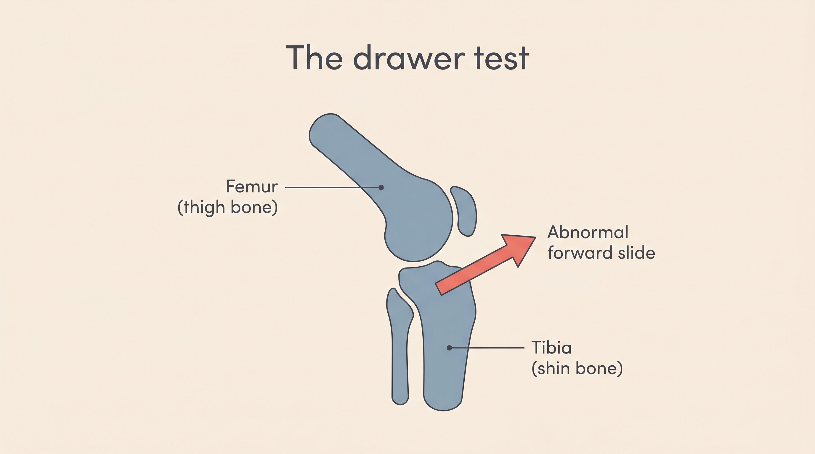 Diagram of the cranial drawer test, the shin bone sliding forward relative to the thigh bone when the cruciate has failed