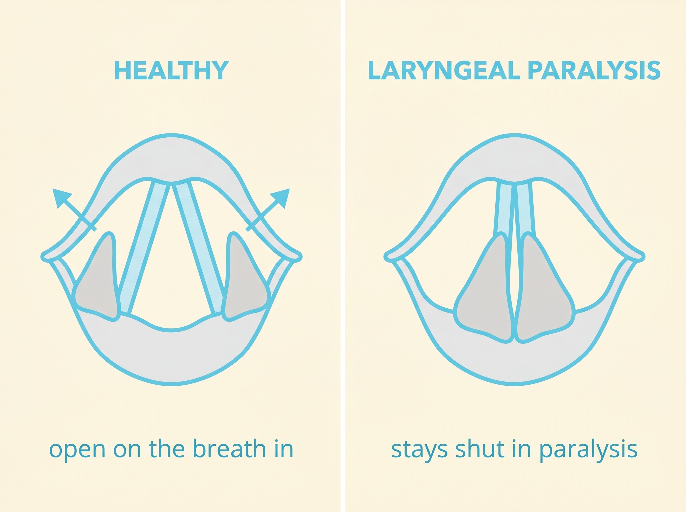 A simple side-by-side diagram of a dog's larynx viewed from above: on the left a healthy larynx with the two arytenoid cartilages drawn wide apart leaving an open triangular airway labelled “open on the breath in”; on the right a paralysed larynx with the cartilages stuck close together leaving only a narrow slit, labelled “stays shut in paralysis”, flat-vector style on a cream background