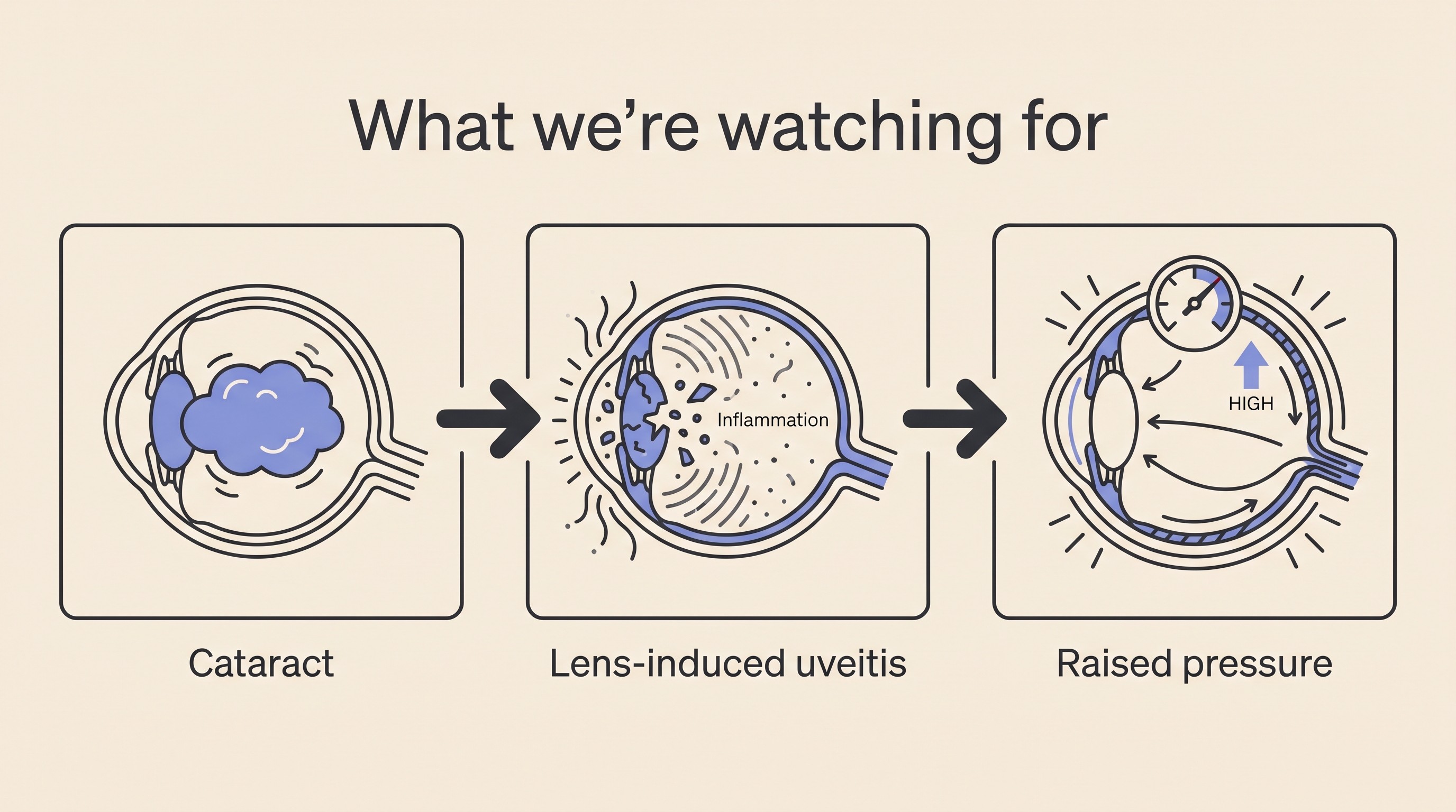 Flat illustration on cream showing the progression from a cloudy cataractous lens, to lens proteins leaking and triggering inflammation inside the eye, to raised pressure, with the heading “What we’re watching for”