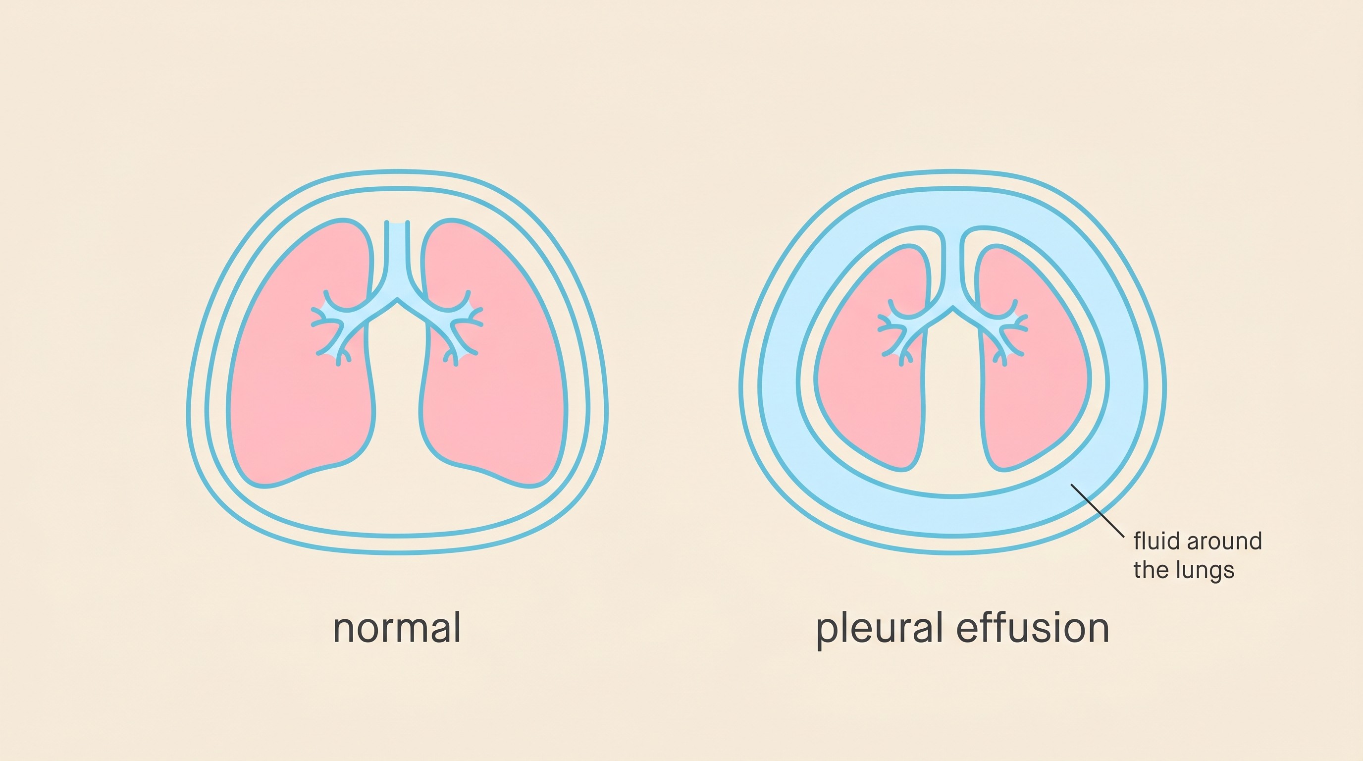 Flat-vector cross-section comparing a normal feline chest with the lungs filling the space against a chest with pleural fluid pressing the lungs into a small compressed wedge, labelled plainly