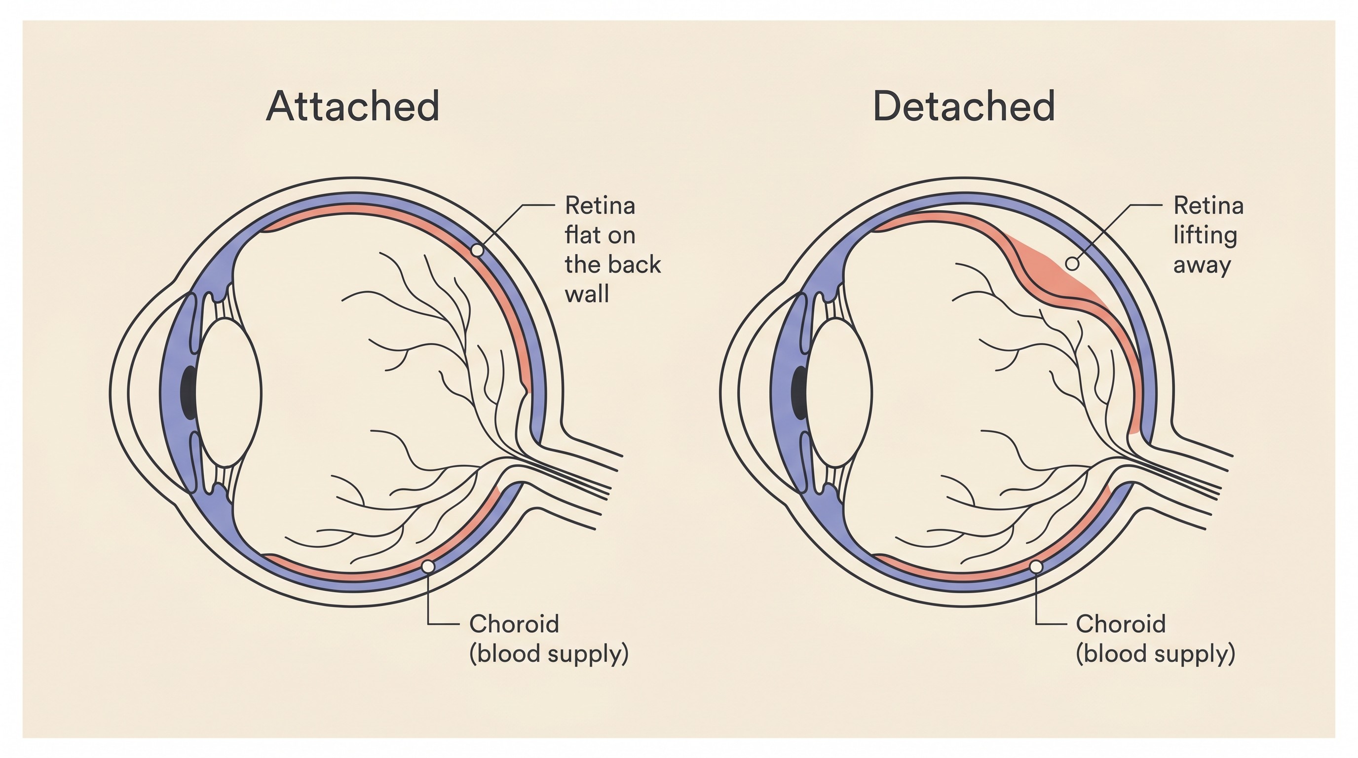 A flat illustration showing a healthy retina lying flat against the back wall of the eye beside a detached retina lifting away into the fluid-filled chamber, with the choroid blood-vessel layer labelled beneath