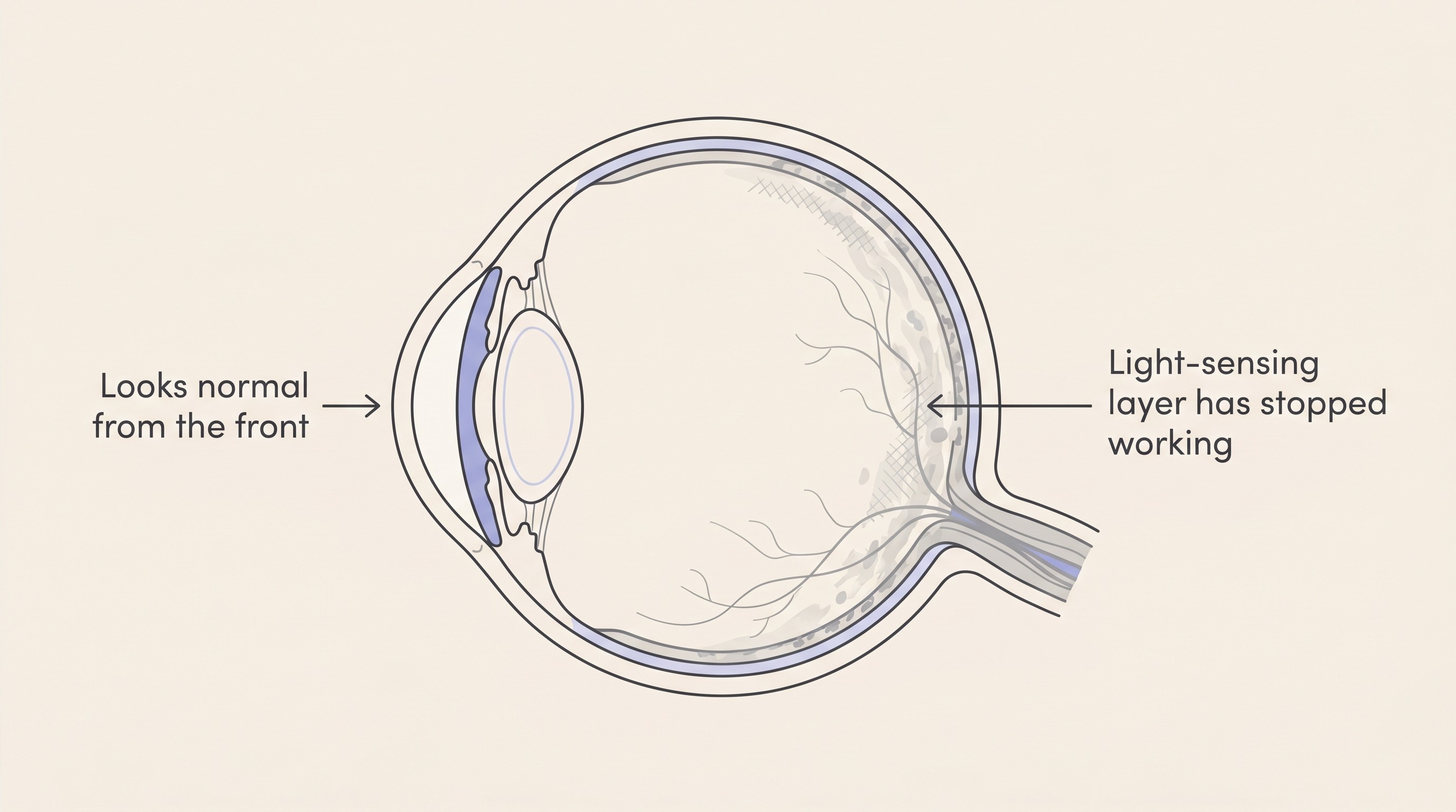 Cross-section of a dog's eye with a clear, normal-looking front and a faded, greyed-out photoreceptor layer at the back