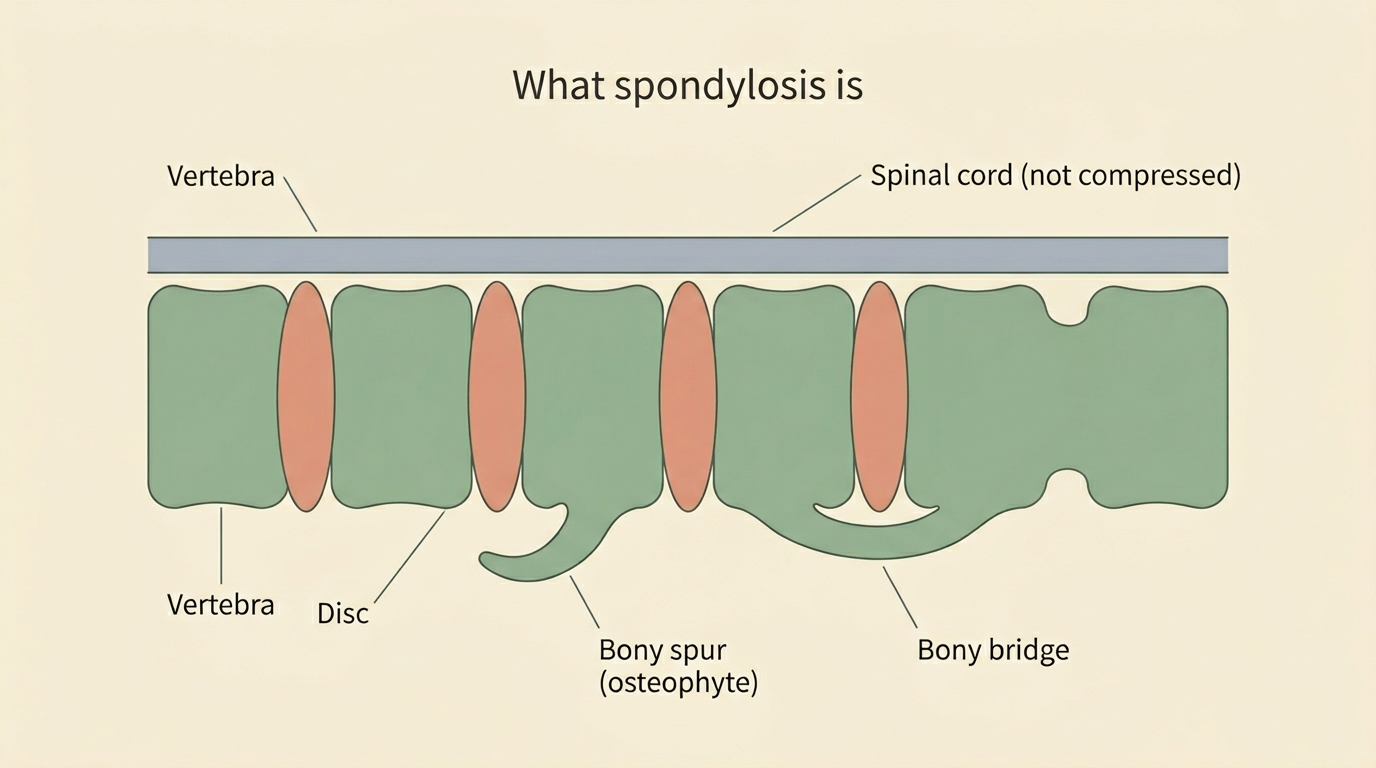A labelled diagram of vertebrae showing osteophytes bridging the disc space